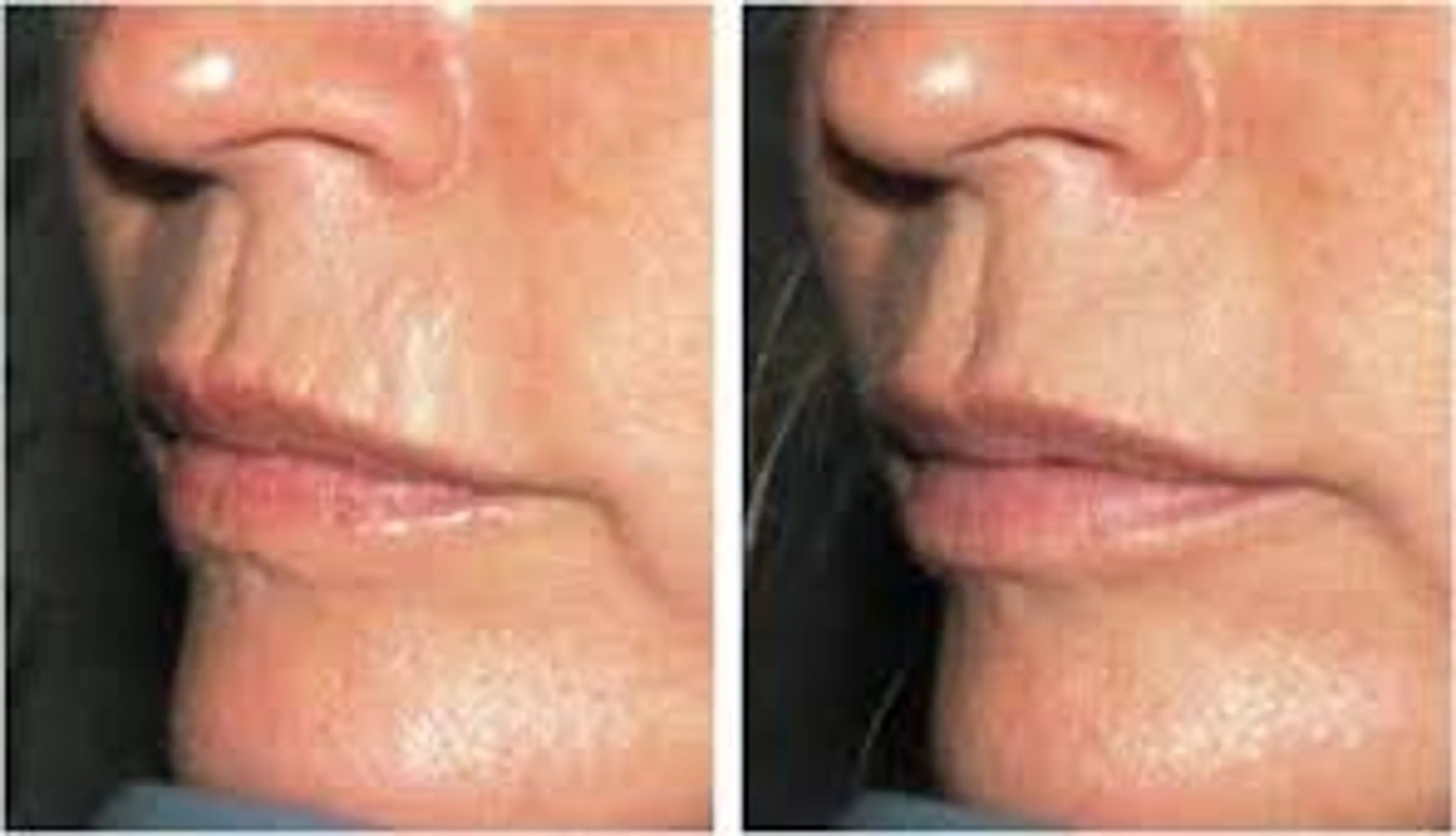 Skin Plumping Reusable Mouth & Lip Treatment Pad